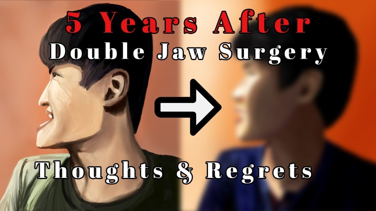 『Double Jaw Surgery In Singapore』『5 Years After – Thoughts &&nbsp;Regrets』