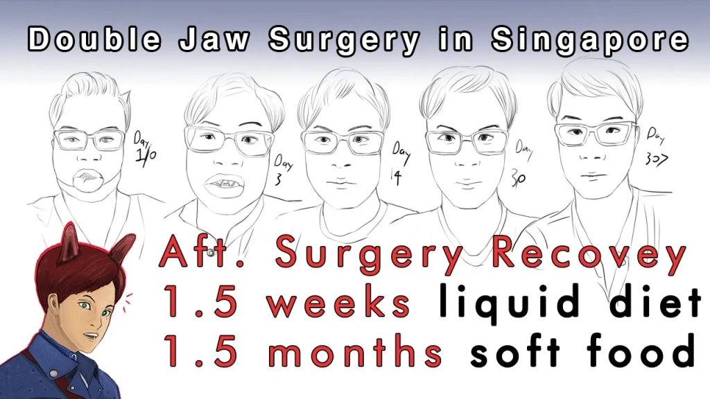 『Double Jaw Surgery In Singapore』『Recovery Process』
