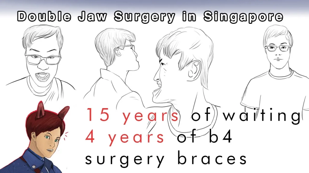 『Double Jaw Surgery In Singapore』『Timeline Before Surgery』